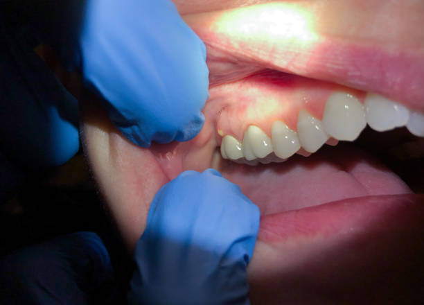 Best Teeth Whitening  in Rose Hill, VA